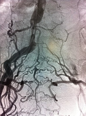 Severe stenosis